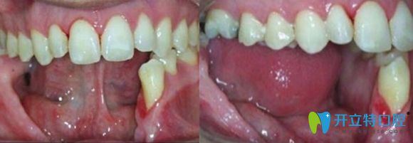 半口種植牙術前照