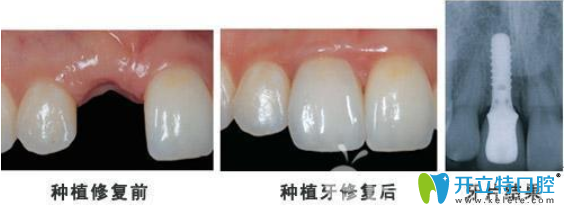種植牙前后對(duì)比