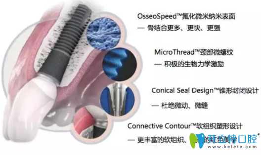 Astra 種植系統(tǒng)的特點(diǎn)有哪些