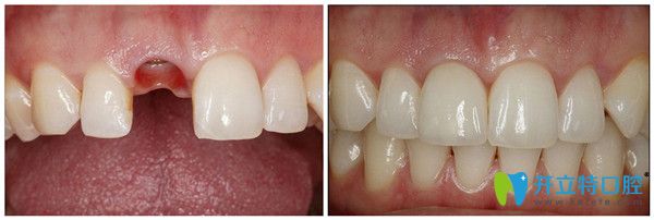 用德國生長因子種植牙技術(shù)做的牙齒