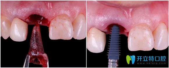 深圳佳美口腔前牙即刻種植案例