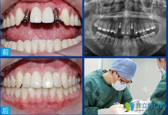 廣州曙光口腔多顆種植牙前后對比圖