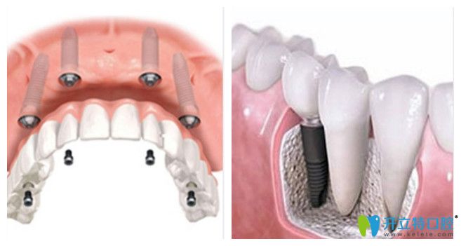 廣州曙光口腔的種植牙技術