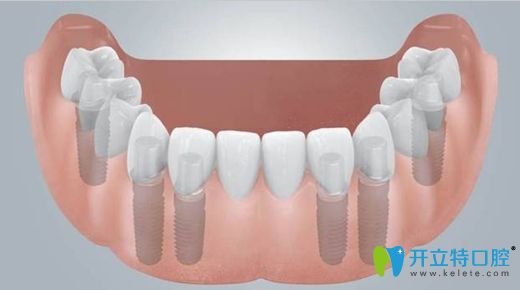 顧騰飛醫(yī)生科普無牙頜全口義齒修復技術(shù) 顧騰飛醫(yī)生科普無牙頜全口義齒修復技術(shù)