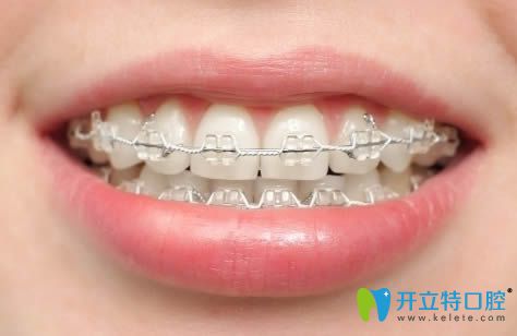 李瑛杰醫(yī)師科普直絲弓與方絲弓矯正區(qū)別 李瑛杰醫(yī)師科普直絲弓與方絲弓矯正區(qū)別