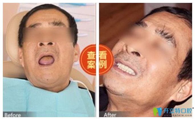 西安中諾顧客全口牙種植前后對比圖