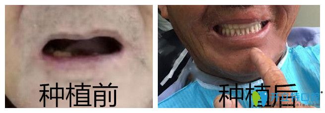 通過ALL-ON-4半口全口種植牙效果來了解靖江艾齒嘉口腔怎么樣