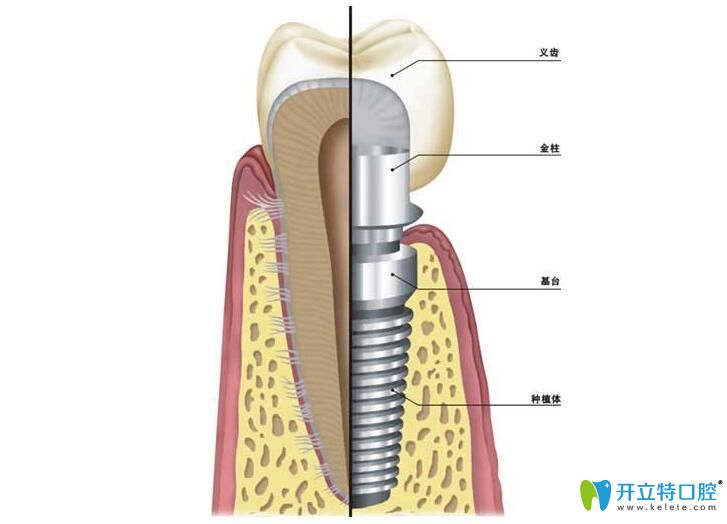恒美口腔對(duì)于種植體、基臺(tái)和牙冠的要求很高