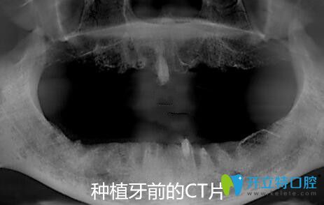 我在寧波恒美口腔做allon4種植前前的CT片