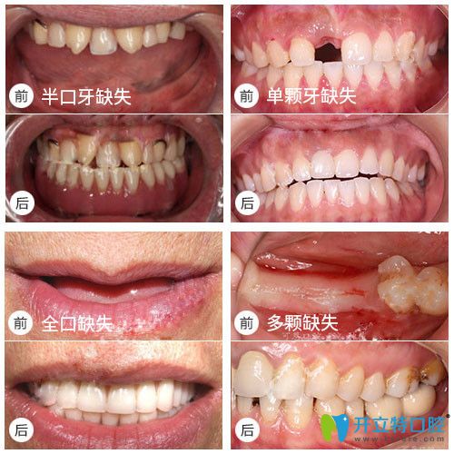 全口，半口種植牙真實案例及前后對比效果