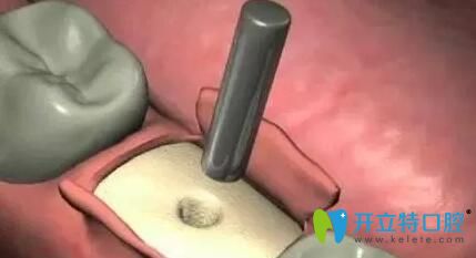 種植體植入圖片