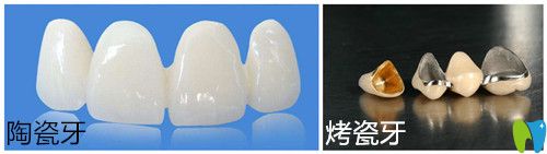 陶瓷牙和烤瓷牙的區(qū)別有哪些?分享兩者價格及優(yōu)缺點給大家