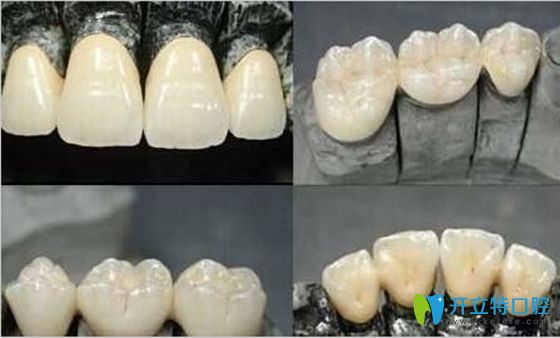 納米烤瓷牙的優(yōu)點(diǎn)有哪些
