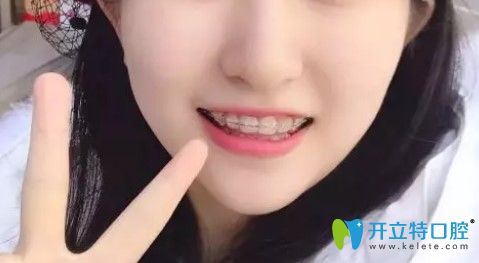 腔牙齒不齊矯正過(guò)程圖