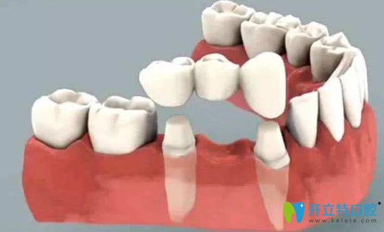 納米烤瓷牙的缺點(diǎn)介紹