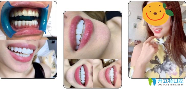 在蘇州康美口腔做了超薄牙貼面前后對比圖