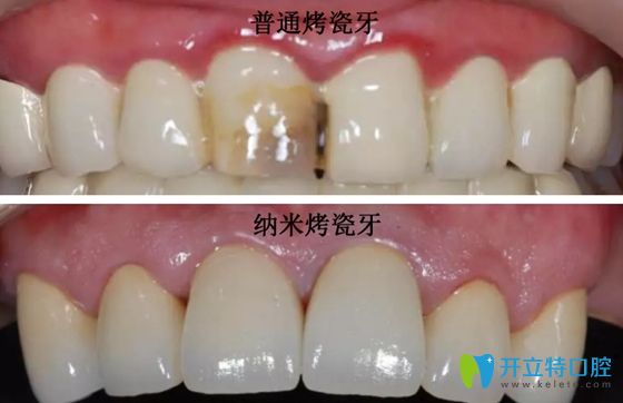 普通烤瓷牙與納米烤瓷牙效果對比圖
