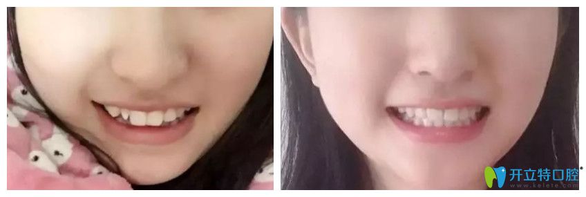<!--<i data=20240703-sp></i>-->美樂(lè)口腔矯正牙齒前后對(duì)比圖