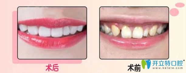 康美超薄牙貼面修復(fù)發(fā)黃牙齒對比照片