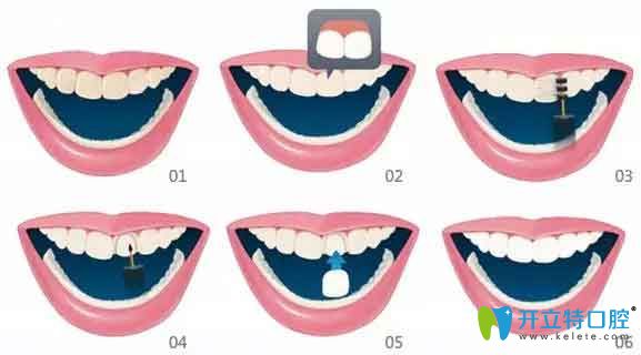 牙齒貼面中的愛威白和美加哪個好,從價格和優(yōu)缺點(diǎn)區(qū)別吧！