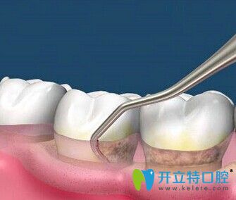 牙齒松動(dòng)齦下刮治治療