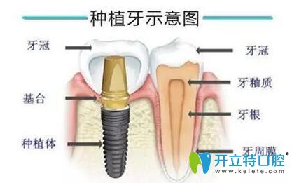 必看！種植牙愈合帽和愈合基臺及愈合基臺和修復(fù)基臺區(qū)別