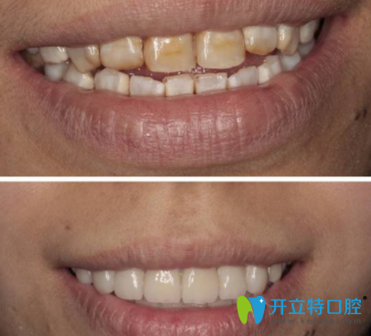 氟斑牙美白前后對比照