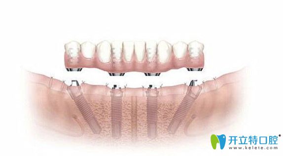 即刻種植牙當(dāng)天就能吃東西？