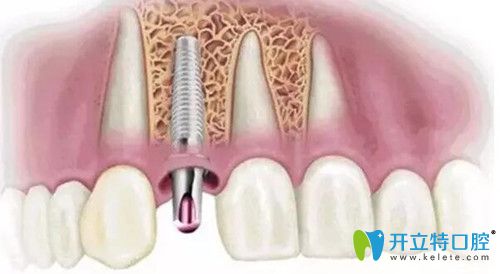 種植牙怎么選？從壽命及價格評測德國camlog種植體怎么樣