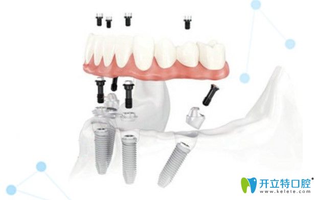 美奧口腔半口即刻種植牙優(yōu)勢