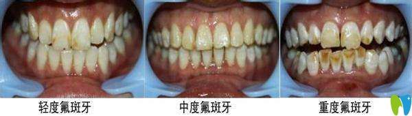 氟斑牙的美白方法大全并附價格表，看看哪種省錢又適合你