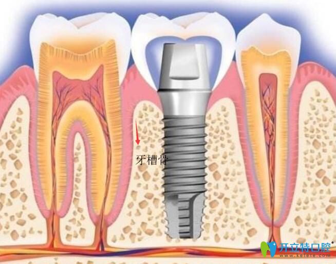 種植體距離上頜竇距離多少安全？穿透上頜竇有什么問題？