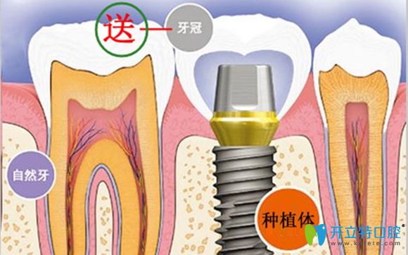 福利放送:深圳龍崗區(qū)僑諾口腔種植牙首顆送全瓷冠啦!