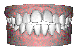 牙齒矯正并不是越快越好