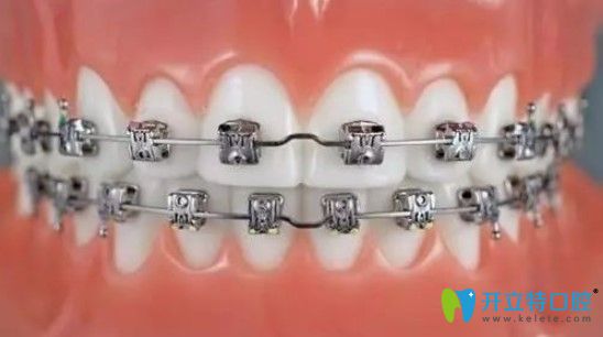 康美口腔進(jìn)口托槽矯正才12800元