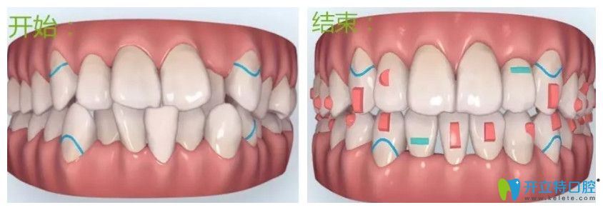 隱適美隱形矯正優(yōu)勢