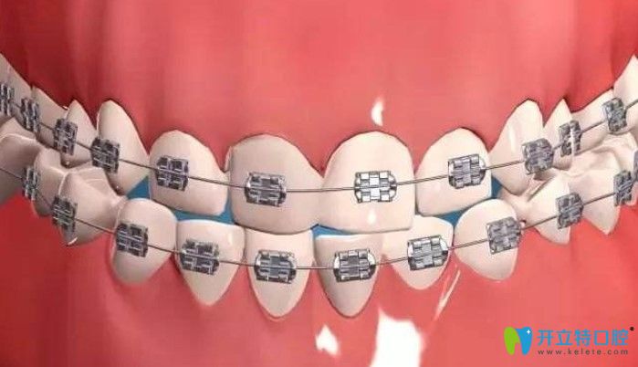 金屬托槽矯正優(yōu)缺點解析