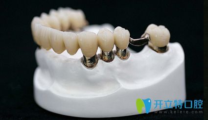 套筒冠義齒修復(fù)牙齒松動(dòng)