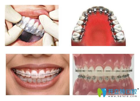 常見(jiàn)的幾種牙齒矯正圖片
