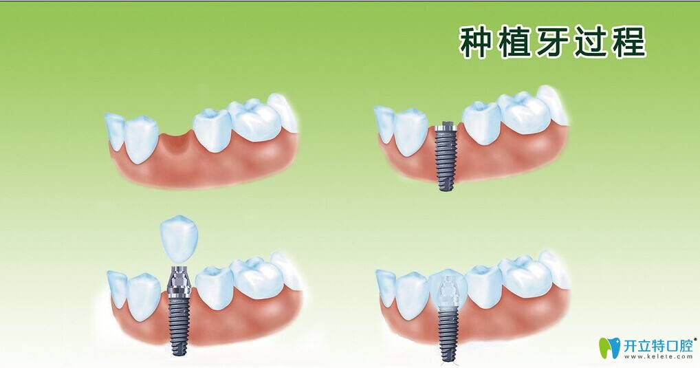 種植牙過程
