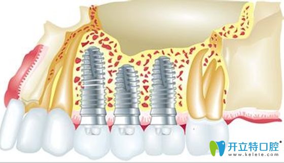 骨量不足種牙不植骨的后果會(huì)怎樣