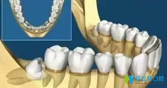阻生牙拔除多少錢？先看看阻生智齒拔除難度有多大