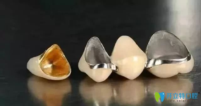 烤瓷牙的效果圖