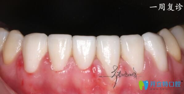 正夫口腔張東峰做牙齒貼面怎么樣
