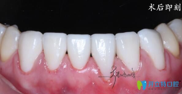 牙齒貼面真人案例