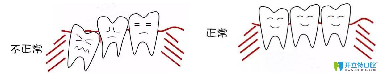 正常的智齒與不正常的智齒圖片