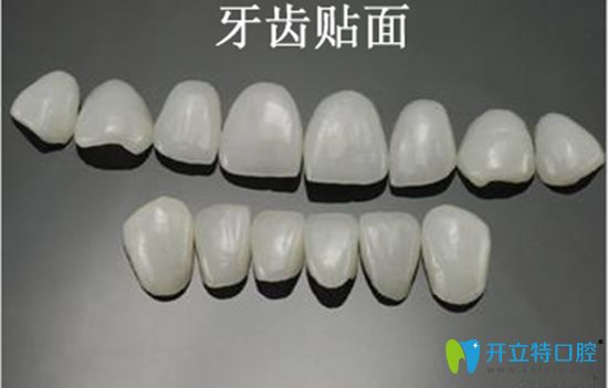 做超薄瓷貼面后悔是有原因的,說下我做牙齒貼面5年后的感受