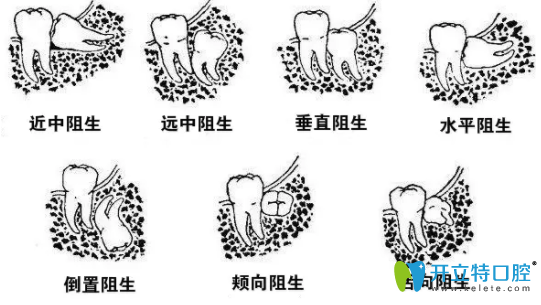 阻生牙生長的形態(tài)