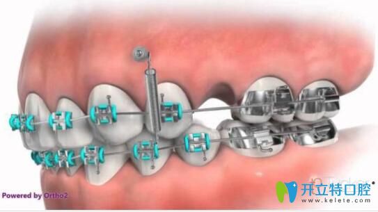 深覆合種植釘矯正