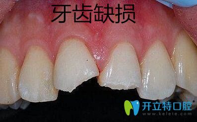 牙齒缺損修復選擇金屬牙冠、烤瓷牙冠和全瓷牙冠哪個好？